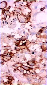 El citoplasma y las membranas de las clulas epitelioides resalatan con el anticuerpo CD34